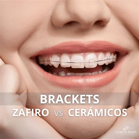 diferencia entre brackets de zafiro y metalicos|ortodoncia brackets precio.